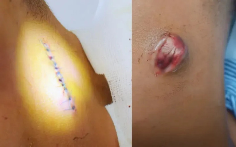 Long An: Nam thanh niên 16 tuổi bị áp xe vùng cổ do mụn