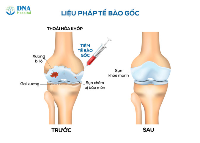 Đau hơn sau khi tiêm tế bào gốc trong điều trị thoái hóa khớp: Điều bình thường và cách xử lý