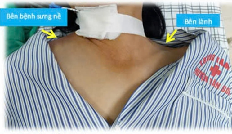 Phú Thọ: Cấp cứu nữ bệnh nhân 54 tuổi tự ý tiêm thuốc tại nhà gây biến chứng nghiêm trọng