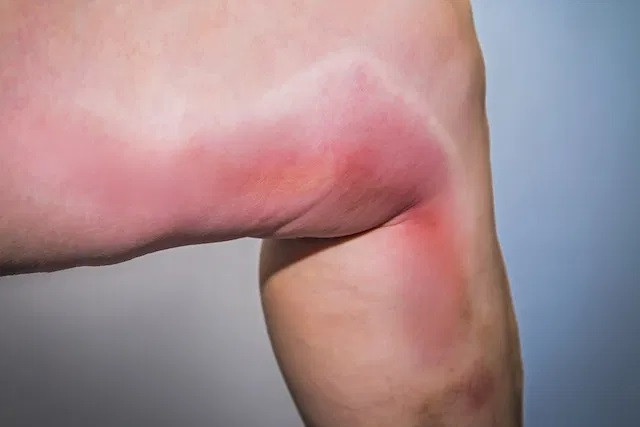 Triệu chứng, nguyên nhân và cách điều trị viêm tĩnh mạch