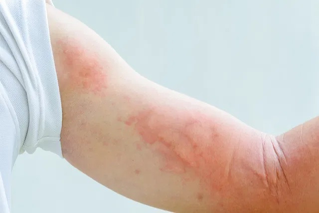 19 nguyên nhân gây đốm đỏ trên da (P1)