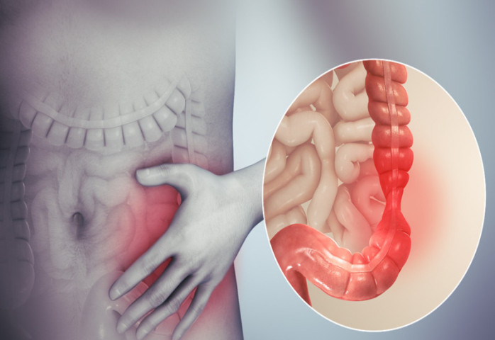 Bài thuốc điều trị bệnh viêm đại tràng