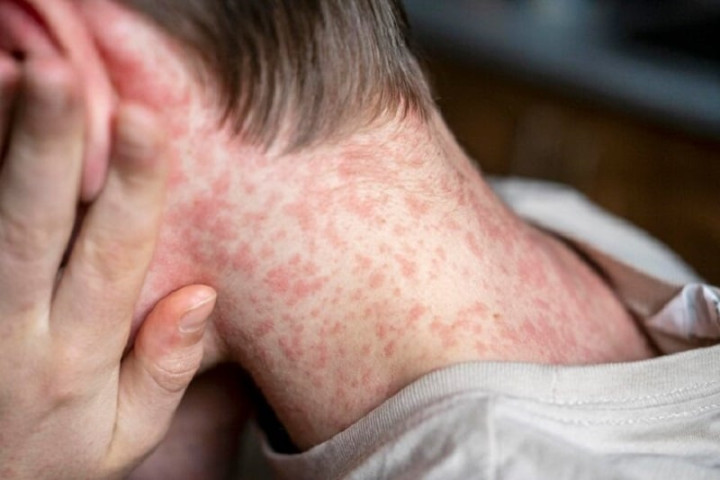 Những điều cần biết về bệnh sởi