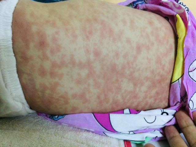 Những điều cha mẹ cần biết về bệnh sởi