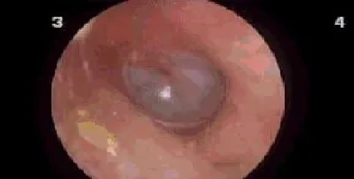 Cố gắng lấy xương cá bị hóc, người đàn ông bị phù nề hạ họng, thanh quản nghiêm trọng