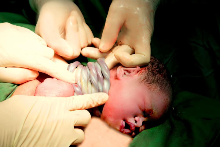 Hà Nội: Một bé gái nặng 2,5 kg chào đời với 9 vòng dây rốn quấn cổ