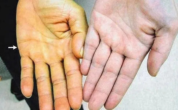 Phú Thọ: Cấp cứu người bệnh ăn lá lộc mại chữa táo bón khiến suy gan, suy thận