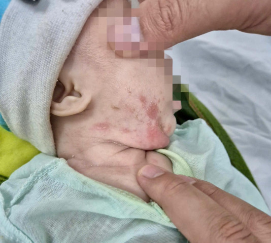 Điều trị cho bé gái 2 tháng tuổi mắc giang mai bẩm sinh