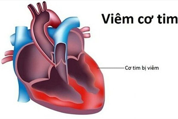 Khánh Hòa cứu sống bệnh nhi 8 tháng tuổi mắc sởi biến chứng viêm cơ tim cấp