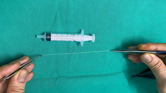 Thanh Hóa: Phẫu thuật gắp con giun dài 14cm trong mắt bệnh nhân
