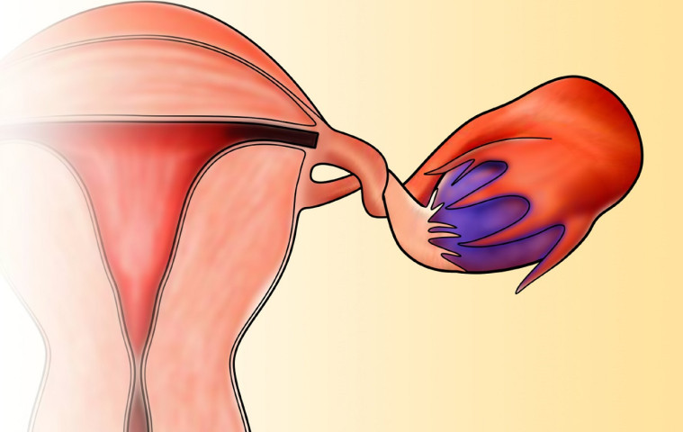 TP. Hồ Chí Minh: Phẫu thuật cấp cứu buồng trứng xoắn cho bé gái 13 tuổi