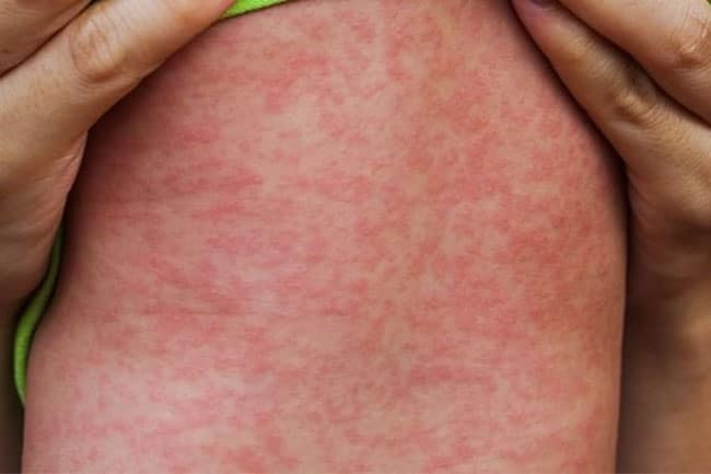 Cách chăm sóc trẻ em bệnh sởi tại nhà