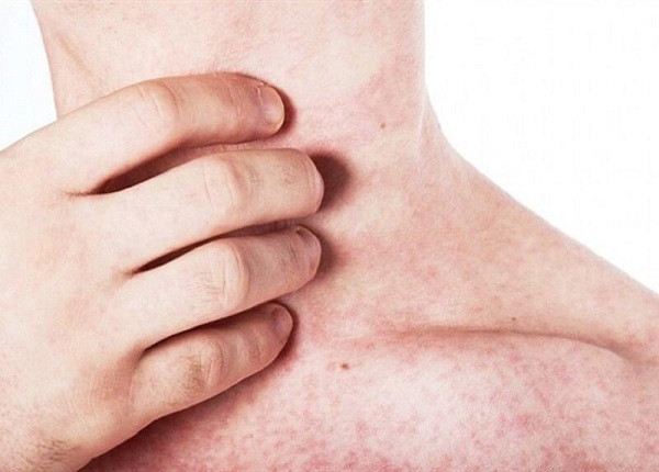 Hà Nội: Ghi nhận 120 ca mắc sởi trong tuần qua