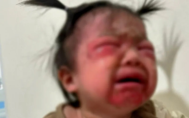 Hải Phòng: Điều trị cho bệnh nhi 18 tháng tuổi mắc hội chứng bong vảy da do tụ cầu