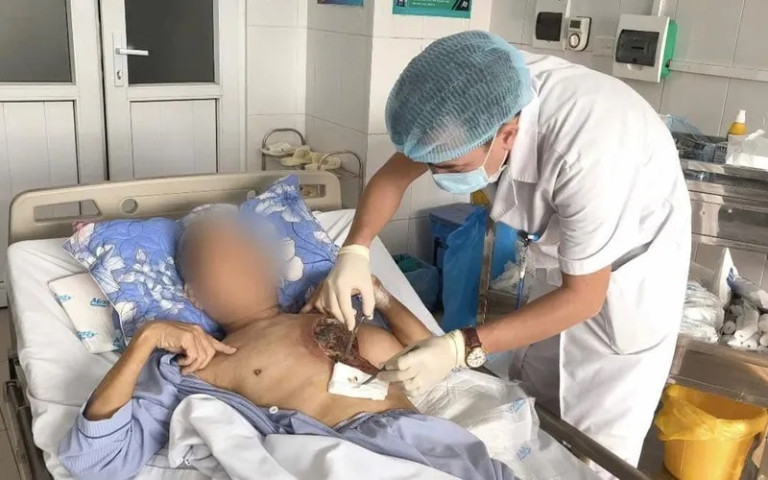 Điều trị cho người đàn ông hoại tử mô cơ vùng ngực trái do mắc nấm hiếm gặp