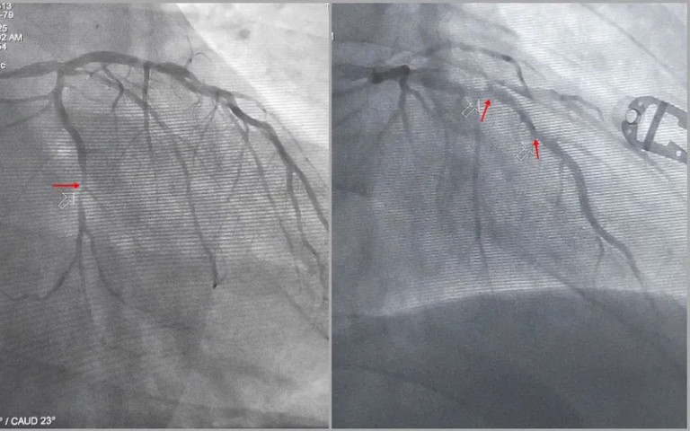 Quảng Ninh: Kịp thời sốc điện cấp cứu, can thiệp đặt stent khẩn cấp để cứu sống bệnh nhân ngừng tim nguy kịch