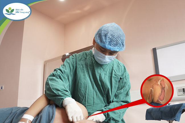 Những tai nạn trẻ thường gặp dịp Tết Nguyên đán và hướng dẫn phòng ngừa, xử trí đúng cách