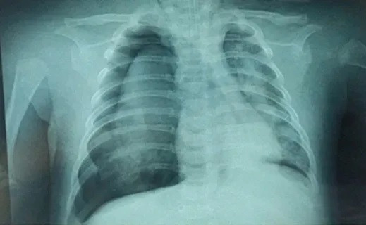 Cần Thơ: Cứu sống bé trai 3 tháng tuổi mắc sởi biến chứng viêm phổi