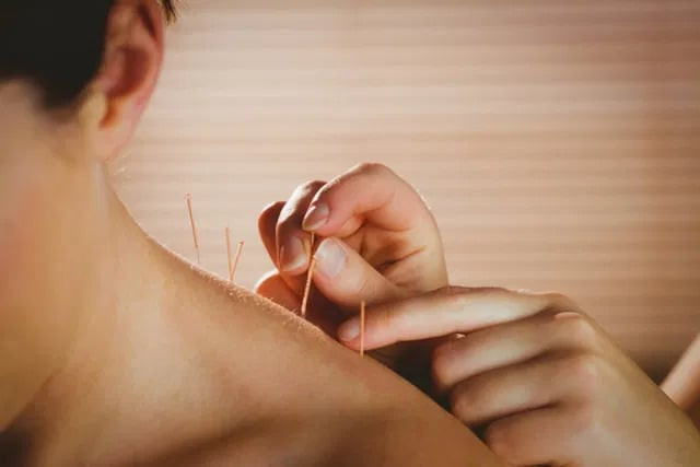 Châm cứu để làm gì và thực hiện như thế nào?