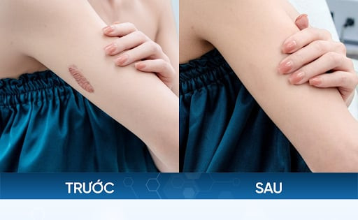 Hàng loạt lời khen của khách hàng sau khi điều trị sẹo tại Phòng khám Chuyên khoa IDE