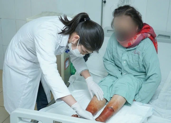 Hà Nội: Điều trị tích cực cho người phụ nữ 60 tuổi hoại tử chân do ngâm bột lạ để giữ ấm