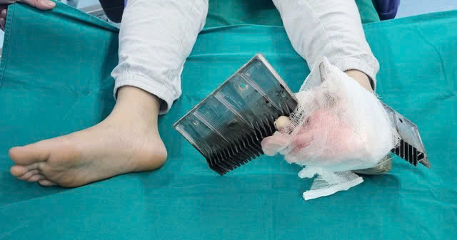 Hà Nội: Phẫu thuật thành công bé trai bị miếng sắt của thang cuốn cắm sâu vào bàn chân