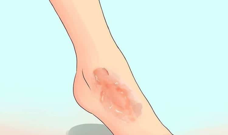 Cách dùng dầu dừa và chanh điều trị bỏng bô xe, viêm da tiết bã nhờn