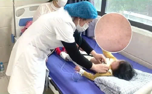 Phú Thọ: Trẻ mắc sởi biến chứng nặng, bác sĩ khuyến cáo cần tiêm vaccine phòng bệnh