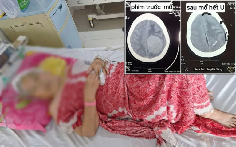 Đắk Lắk: Phẫu thuật thành công bệnh nhân có khối u não lớn