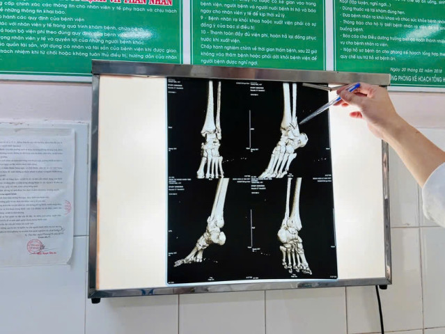 TP. Hồ Chí Minh: Người phụ nữ bị gãy lún 3 mắt cá chân trong lúc nhảy dây