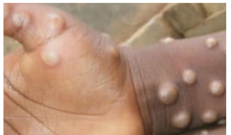 Châu Phi: Dịch viêm màng não ở Nigeria và đậu mùa khỉ ở Tanzania diễn biến phức tạp