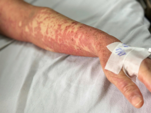 Hà Nội: Điều trị tích cực cho cụ bà bị dị ứng thuốc nặng khiến toàn thân mẩn ngứa  và men gan tăng cao