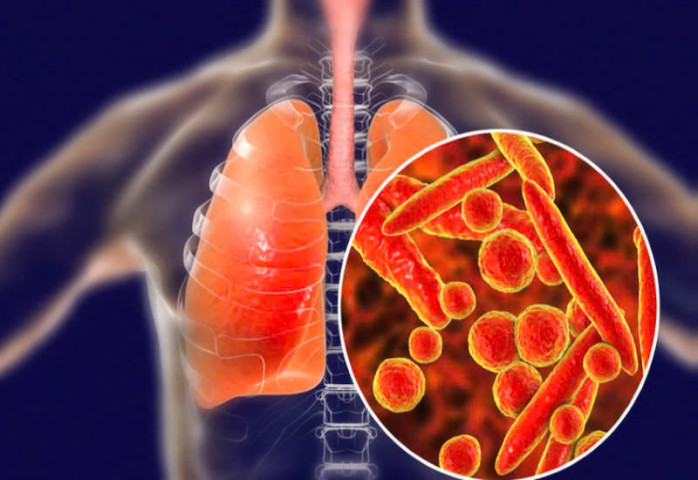 Hà Nội: Thay huyết tương cứu sống người phụ nữ nguy kịch do mắc lao phổi và Lupus ban đỏ