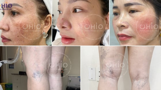 Giãn mao mạch: Nguyên nhân và phương pháp điều trị