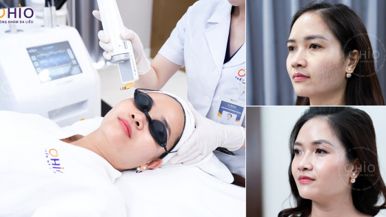 Giãn mao mạch gây mất thẩm mỹ khiến chị em tự ti
