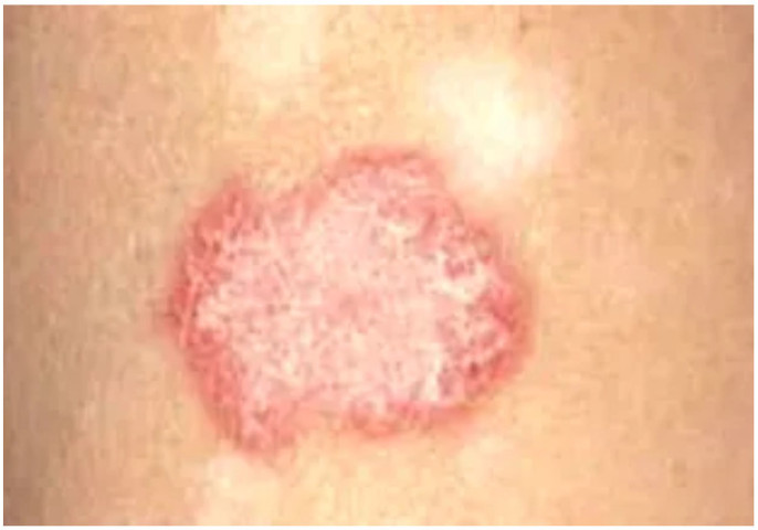 Ninh Thuận: Điều trị thành công cho 2 bệnh nhân bị lupus ban đỏ hệ thống