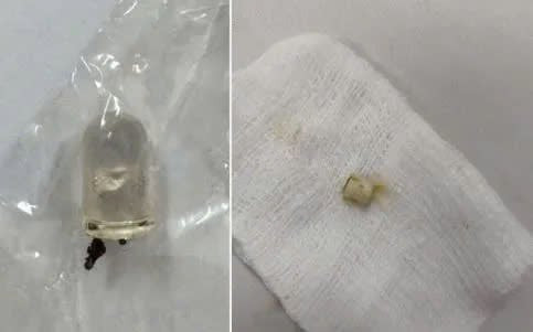 Đắk Lắk: Bé trai 6 tuổi mắc nhiều dị vật đường thở trong suốt 1 tháng