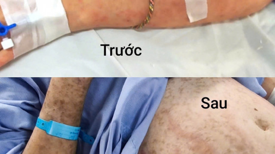 Hà Nội: Nam thanh niên 26 tuổi hoại tử da do dùng thuốc cảm tùy tiện