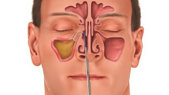 Tự ý điều trị viêm xoang có thể dẫn đến biến chứng nguy hiểm