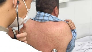 Không chỉ ở trẻ em, người lớn mắc sởi cũng dễ gặp biến chứng nặng