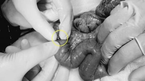 TP Hồ Chí Minh: Bệnh nhi 4 tuổi phải cắt ruột do nuốt 15 viên nam châm