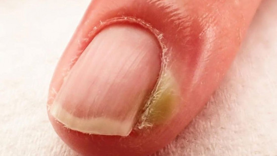 Thực hư cắt móng tay quá ngắn có nguy cơ bị bệnh tim?
