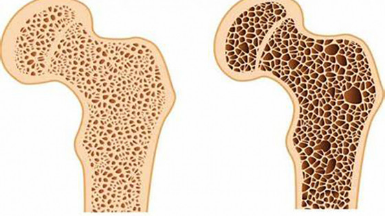 5 cơn đau nào là dấu hiệu của bệnh loãng xương?