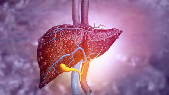 Gan nhiễm mỡ: Những dấu hiệu âm thầm bạn cần cảnh giác