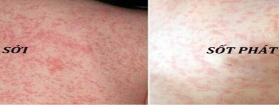 Biến chứng nguy hiểm của bệnh sởi ở trẻ em