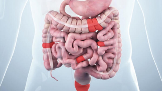 Bệnh Crohn - Sát thủ thầm lặng trong hệ tiêu hóa