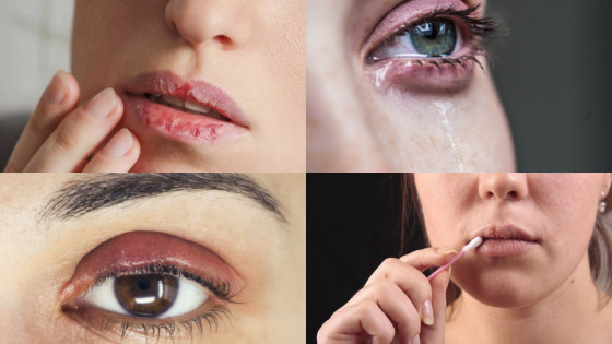 Phun xăm môi, mắt: Cảnh báo những biến chứng không thể xem nhẹ