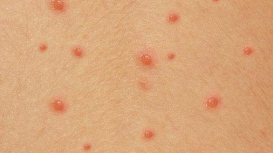 Cảnh báo biến chứng nguy hiểm của bệnh thủy đậu
