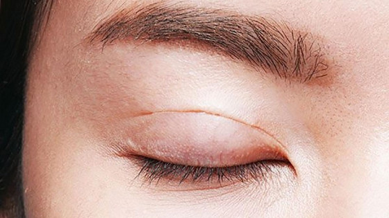 Quy trình và thời gian hồi phục sau cắt mí như thế nào?