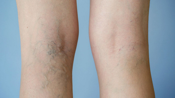 Giãn tĩnh mạch chân: Nhận biết sớm, tránh biến chứng